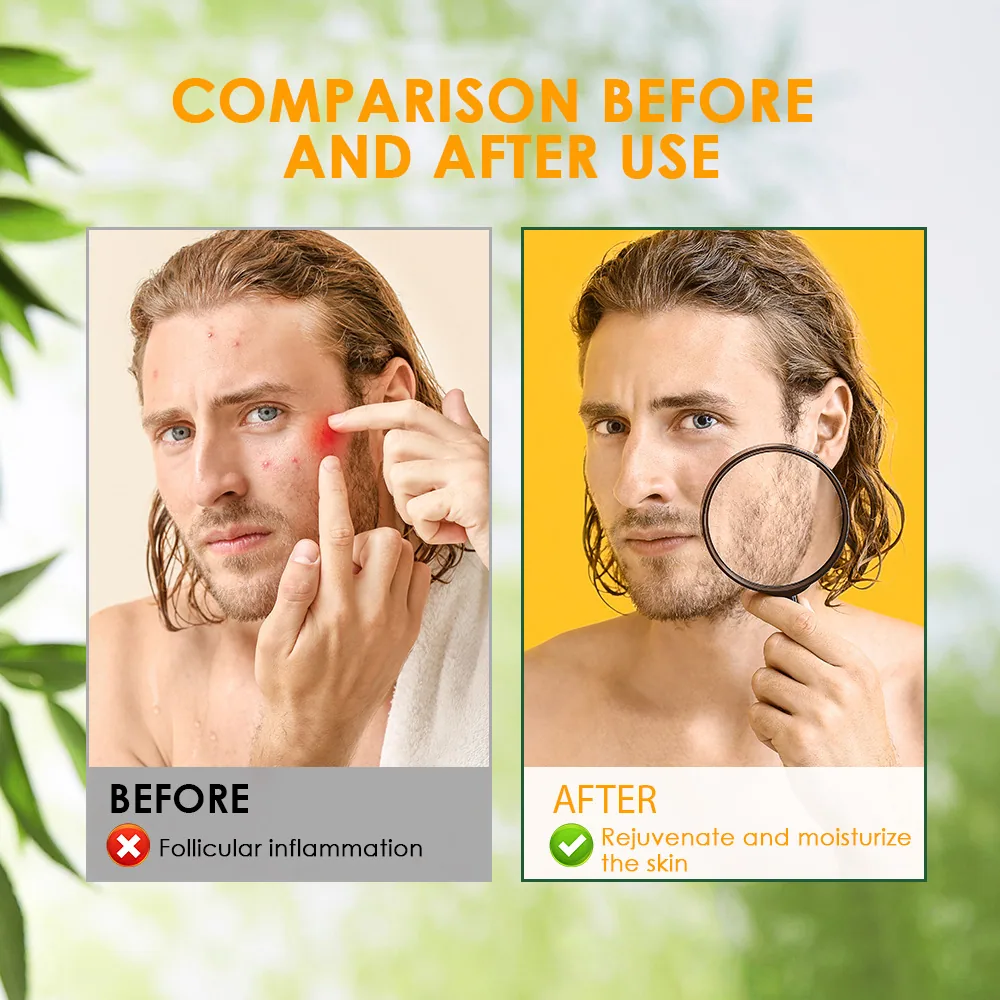 Sumifu Amazon Temu AliExpress Hair Follicle Cream Skin Care Folliculitis Pores Coarse K10108 4