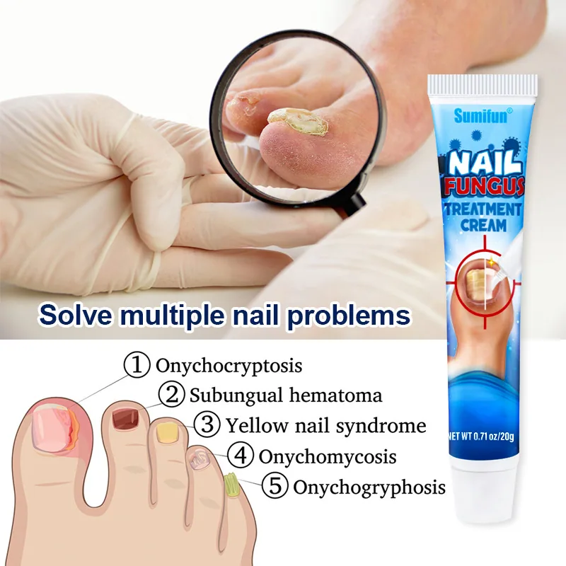 Lazada AliExpress Sumifu Cross Border 20g Nagelcreme Grauer Nagel Weiche Nagelentfernungssalbe K10010 12