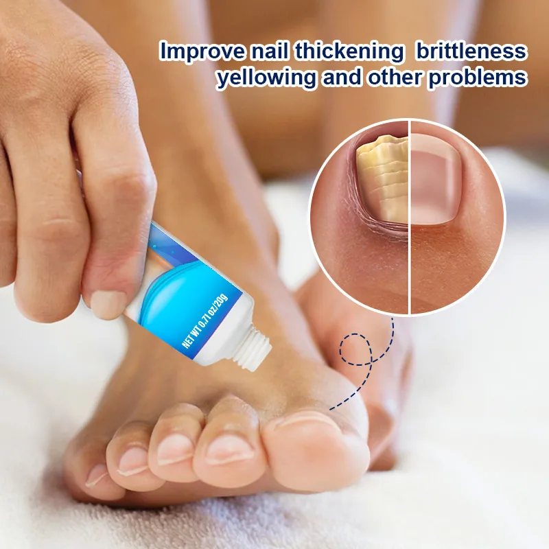 Lazada AliExpress Sumifu Cross Border 20g Nagelcreme Grauer Nagel Weiche Nagelentfernungssalbe K10010 10
