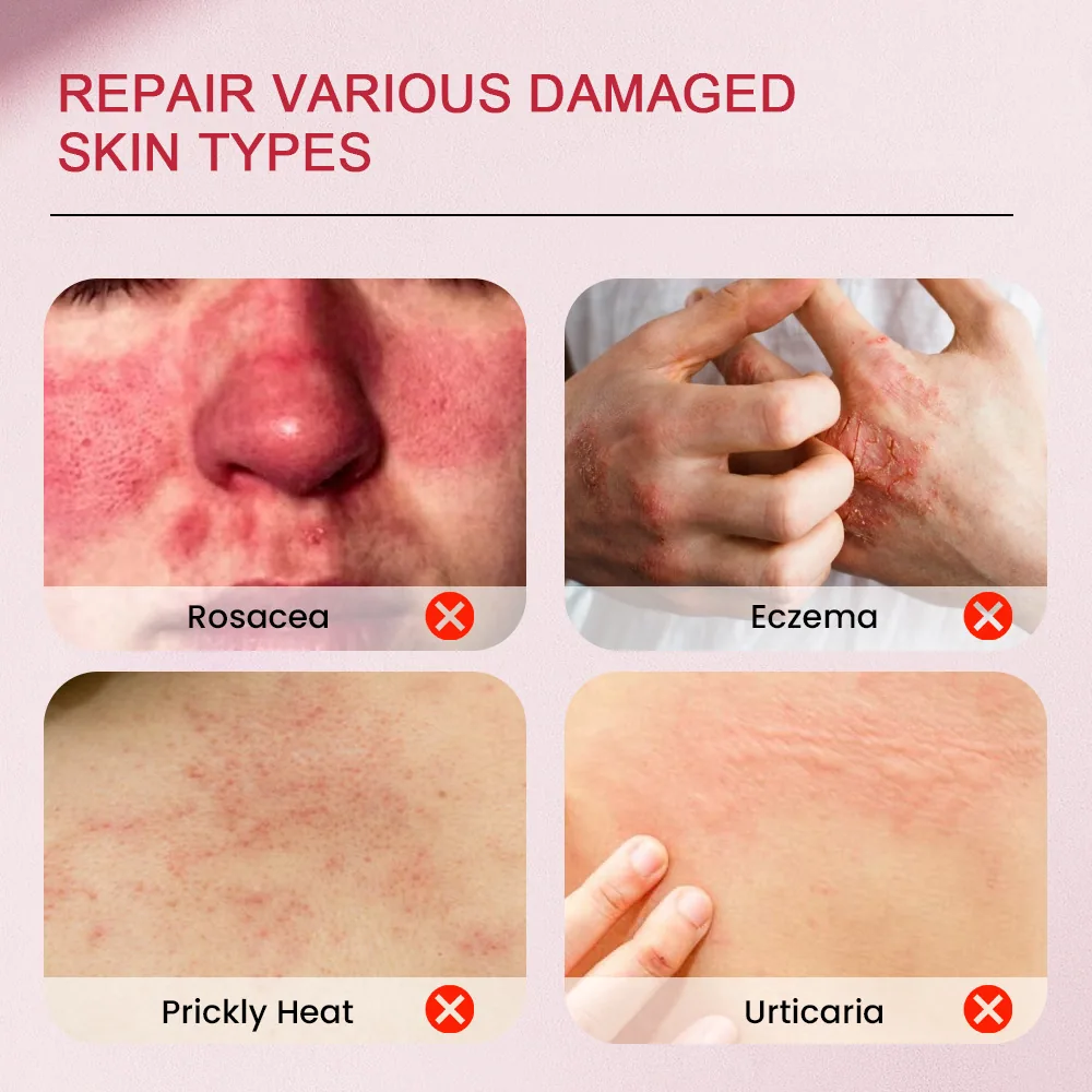 Sumifu Cross border Acne Cream AliExpress Lazada Amazon Shopee Hearthstone Skin Care K10181 17