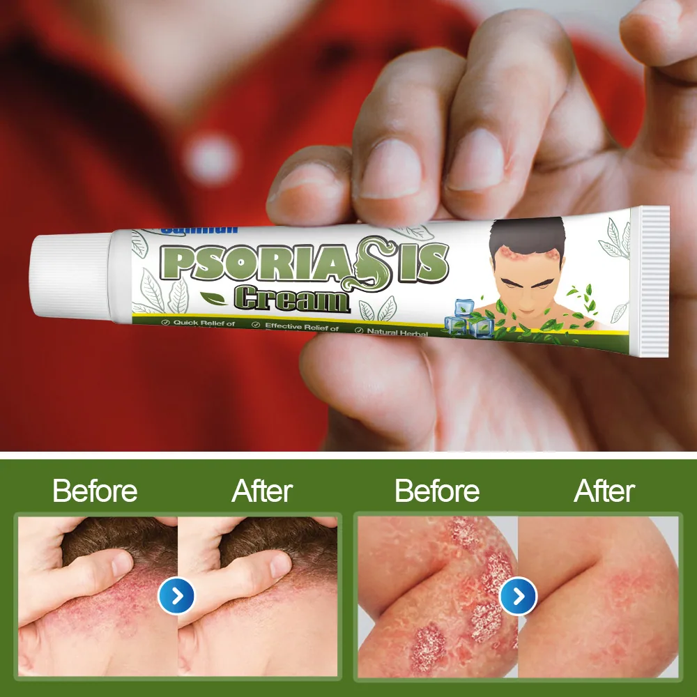 Sumifu Amazon TEMU Cross border Psoriasis Soothing Cream for Forehead Hair Body Care Cream k10134 8