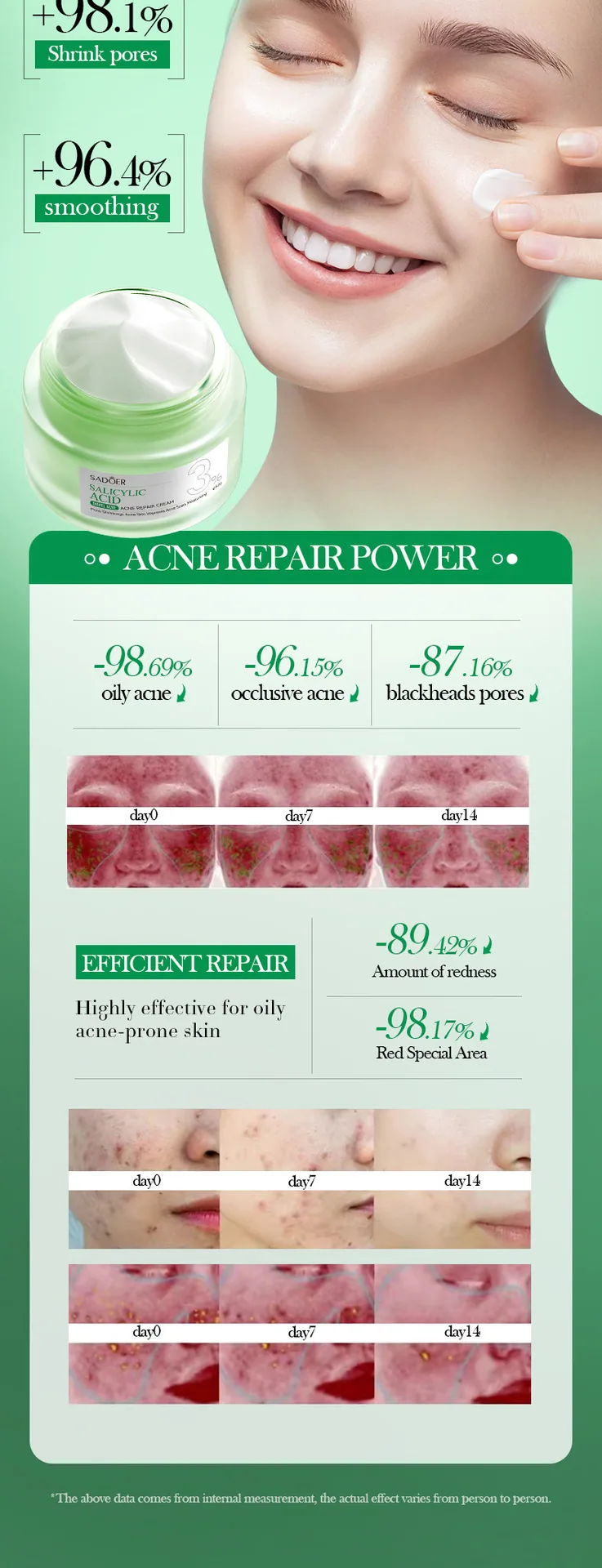 SADOER Salicylic Acid Repair Cream Composition and Efficacy Diagram, Student Moisturizing face cream Acne Removing Principle 