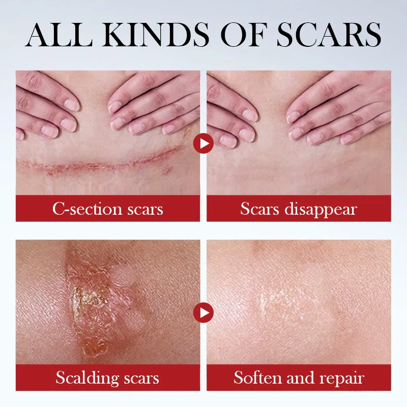 SADOER Scar Repair Cream Facial and Body Dual Use Application Method Demonstration Cross border Foreign Trade Wholesale
