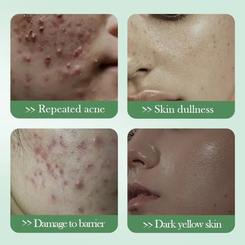 SADOER Salicylic Acid Acne Removing&Repairing essence, Moisture Replenishing&Refreshing Lotion, Cross border Wholesale Skin C