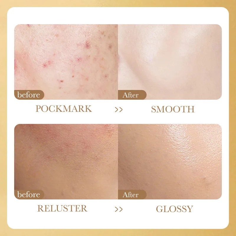 SADOER Niacinamide Vitamin C Freeze-Dried Powder Set Pore-shrinking Anti-Wrinkle Freeze-Dried Powder Wholesale - Face & Body Mask 5