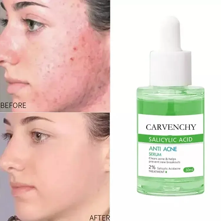Grenzüberschreitendes exklusives ANTI ACNE SERUM Akne klärende, beruhigende, feuchtigkeitsspendende, straffende Akne-Serum-Essenz 3