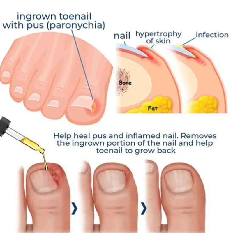 ToenailPlus Anti-Nail Groove Relief Oil Soft Nail Shine Nail Repair Ingrown Nail Thickening Nail Groove Care Oil 7