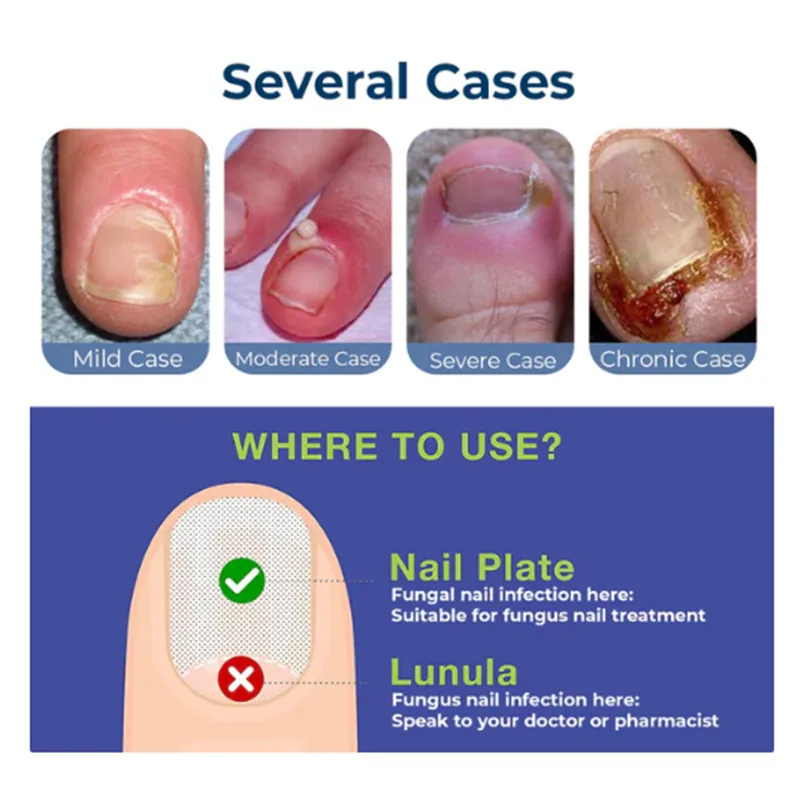 ToenailPlus Anti-Nail Groove Relief Oil Soft Nail Shine Nail Repair Ingrown Nail Thickening Nail Groove Care Oil 2