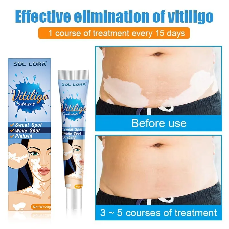 SOL LORA Cross-border Pieplaque Care Health Balm White Spot Cleansing Ointment Spot Sweat Spot Vitiligo Skin Topical Cream 4