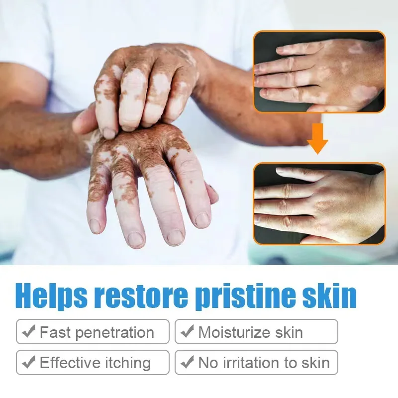 SOL LORA Cross-border Pieplaque Care Health Balm White Spot Cleansing Ointment Spot Sweat Spot Vitiligo Skin Topical Cream 3