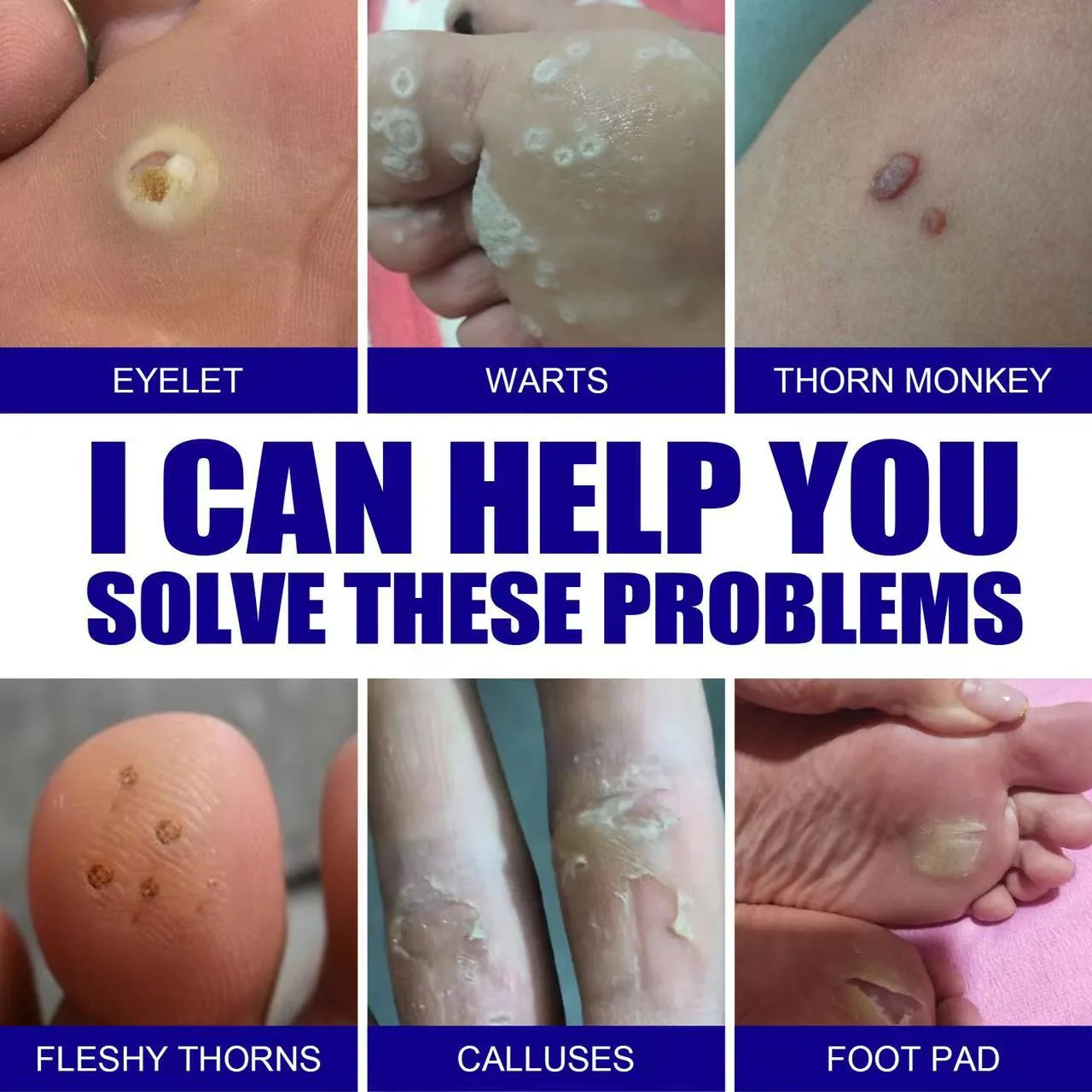 SOL LORA Cross-border Amazon AliExpress Wart Removal Cream Wart Flat Wart Removal Filament Wart Cream Corn Eye Mole Cream 6