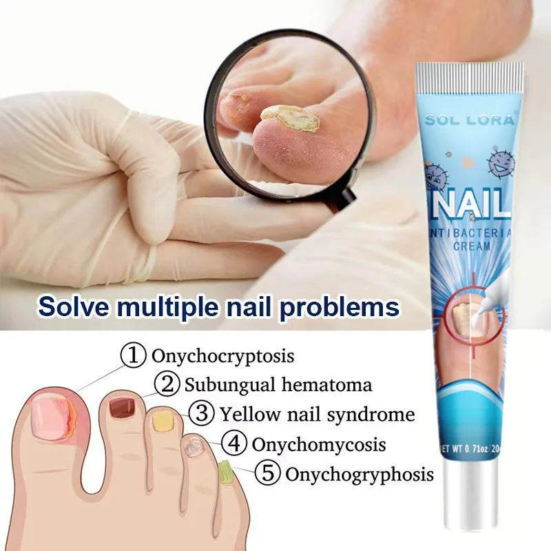 SOL LORA Amazon temuWish AliExpress 20g Nail Cream Nail Fungus Soft Nail Removal Ointment 4