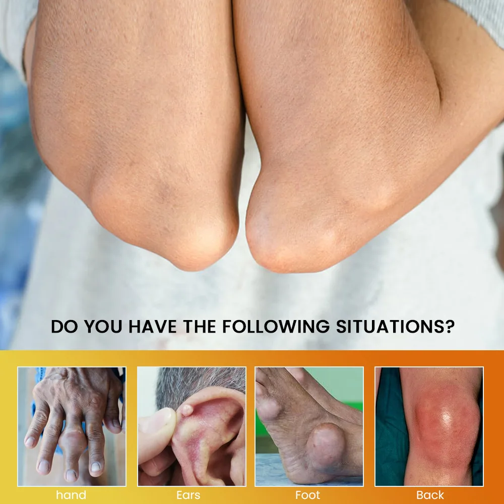 sumifun cross-border plaster joint swelling cream big toe swelling gout type plaster manufacturer wholesale k10174 11