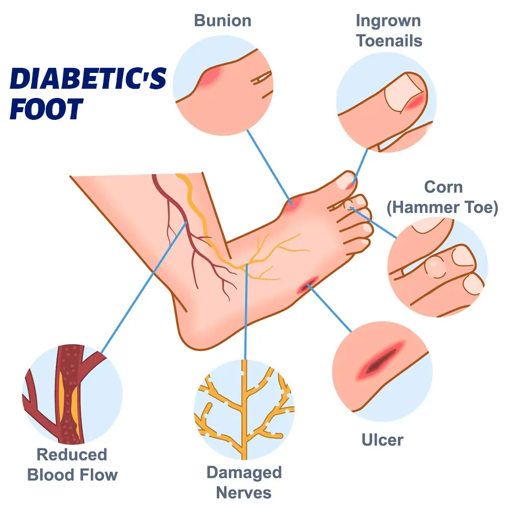 sumifun Tangning Foot Care Cream Amazon AliExpress Cross-border Plaster Abnormal Blood Sugar Cream K10274 9