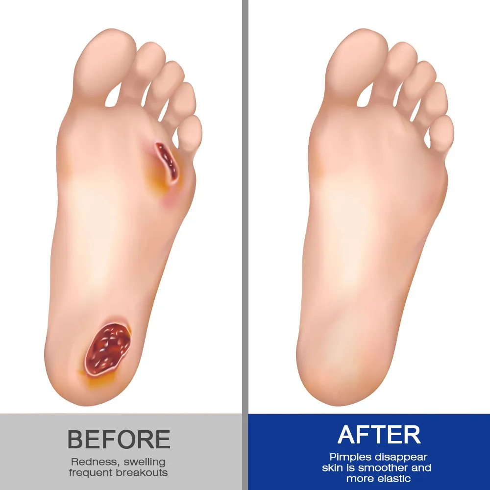sumifun Tangning Foot Care Cream Amazon AliExpress Cross-border Plaster Abnormal Blood Sugar Cream K10274 11