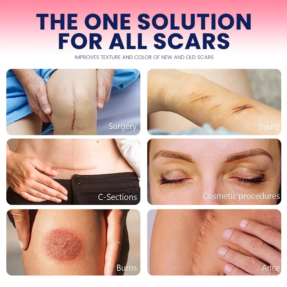پچ ترمیم کننده اسکار ژل سیلیکونی Sumifun Patch مکانیکی Scar Scar Skin Scar Repair Scar Scar K000013 16