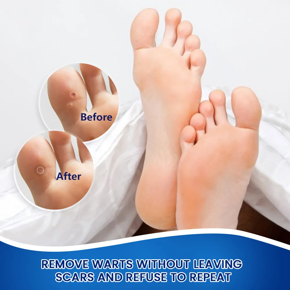 Sumifun foot wart removal cream cross-border explosive Russian foreign trade spot foot warts corn eye wart flat K10149 7