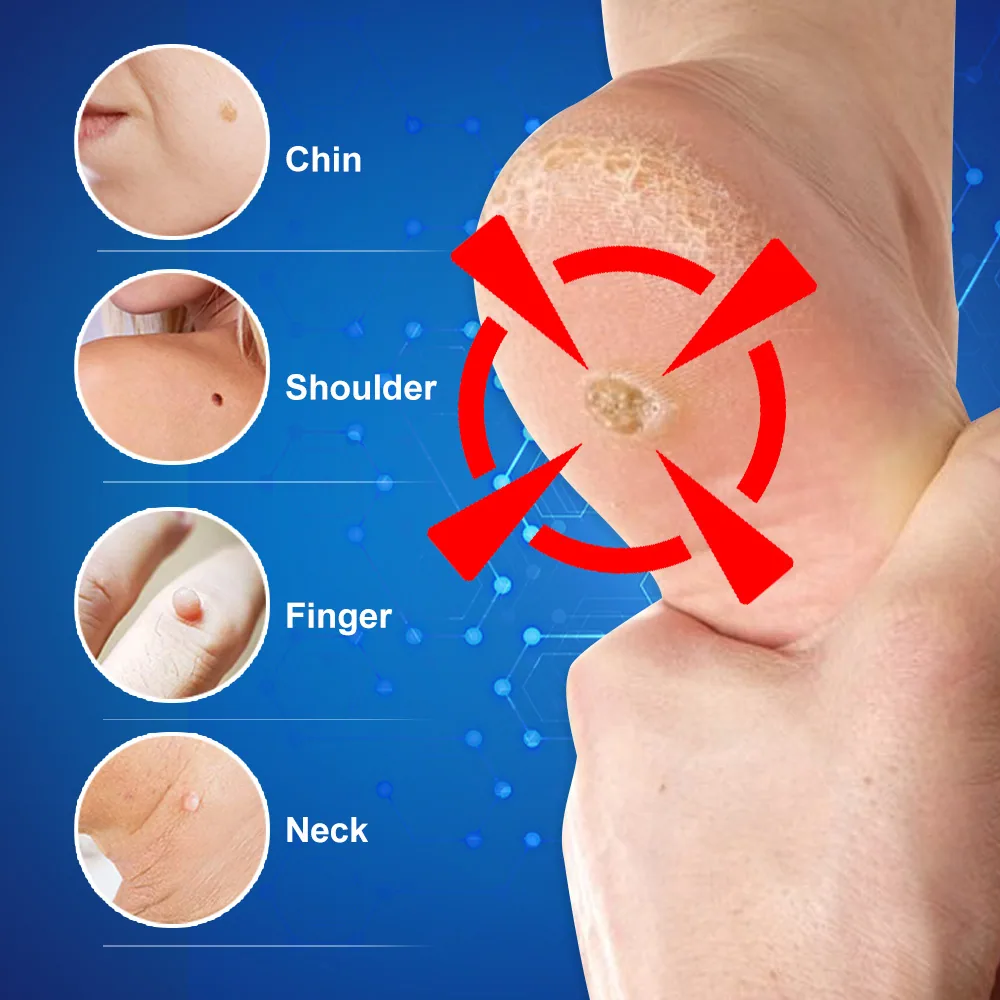 Sumifun foot wart removal cream cross-border explosive Russian foreign trade spot foot warts corn eye wart flat K10149 8