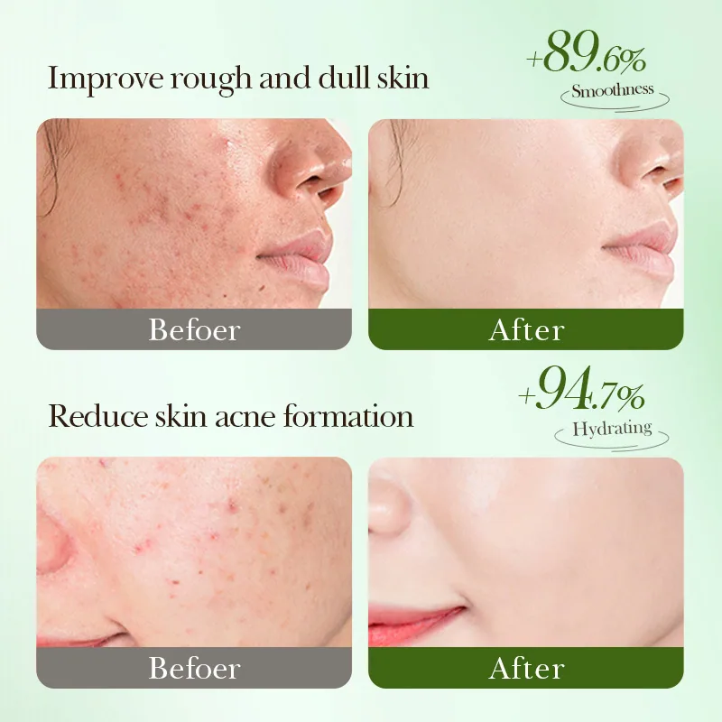 SADOER salicylic acid anti-acne soothing repair hydrating mask sachet texture close-up for cross-border wholesale